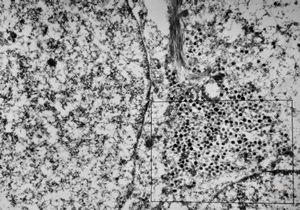 F, 71y. | Merkel cell tumor F, 71y. | Merkel cell tumor
